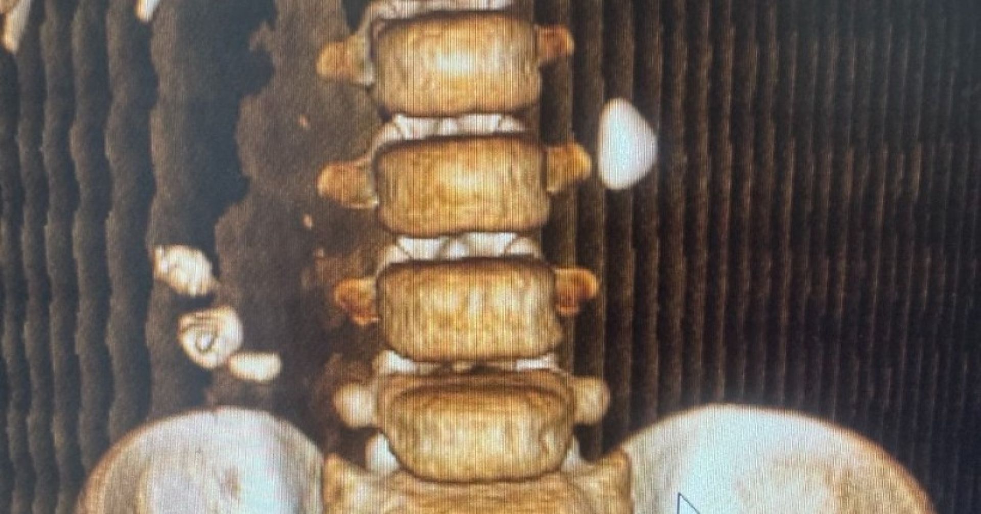 рентген почек