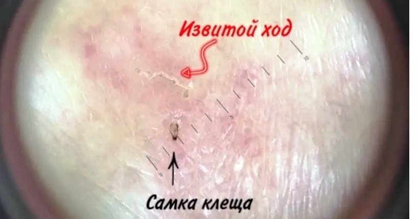 Под Новосибирском медик обнаружила чесоточного клеща с помощью дерматоскопа